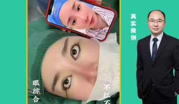 眼综合四项